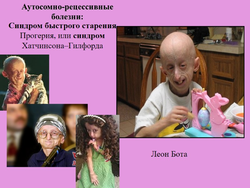 Синдром быстрого старения Прогерия, или синдром Хатчинсона–Гилфорда Леон Бота  Аутосомно-рецессивные болезни: